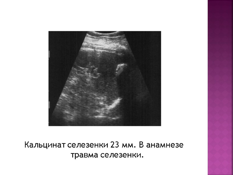 Кальцинат селезенки 23 мм. В анамнезе травма селезенки.